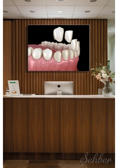 Diş Kaplama Veneer Uygulaması Sürecinin 3 D Aşamaları Tıbbi İllüstrasyon Yatay Kanvas Tekli Tablo 3671