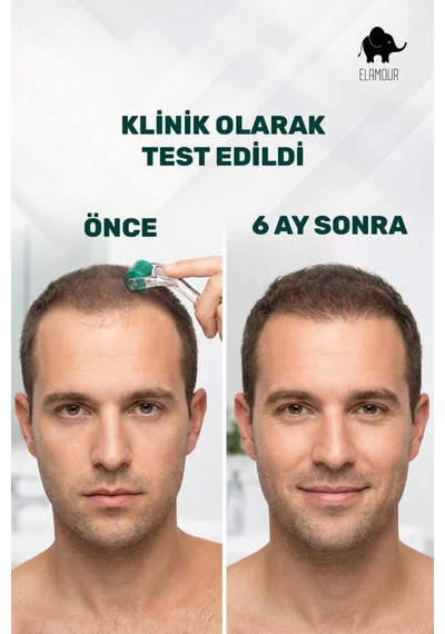 0,50mm 540 Iğneli Saç Ve Cilt Bakım Dermaroller - Orijinal Titanyum Iğneli - Serum Seti Hediyeli