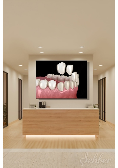 Diş Kaplama Veneer Uygulaması Sürecinin 3 D Aşamaları Tıbbi İllüstrasyon Yatay Kanvas Tekli Tablo 3671