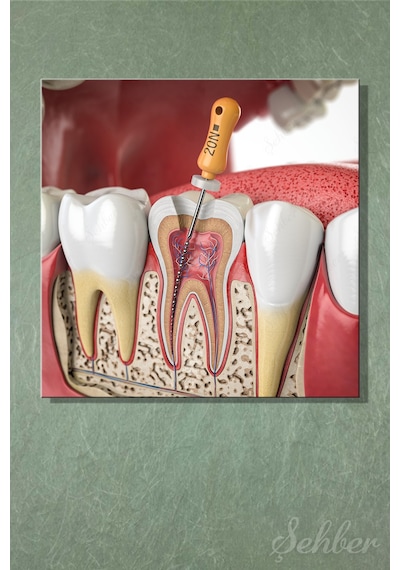 Endodontik Tedavi Kanal Tedavisi Prosedürü 3d Tıbbi İllüstrasyon Yatay Kanvas Tablo 3862 Çok Renkli