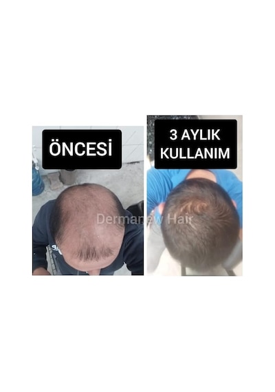 Ayrex Dermanew Saç Büyüme Serumu, Hair, 50 Ml, 10'lü Set - Hair