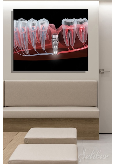 Dental İmplant Tıbbi 3d Çizim Yatay Kanvas Tablo Tekli Ağız Diş Sağlığı Dişçi Poliklinik Hastane 3497