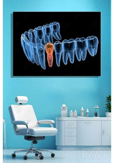 Diş İmplantı Yapay Diş Kökü Tıbbi Ve Anatomik 3 Boyutlu İllüstrasyon Yatay Kanvas Tablo Tekli 3659