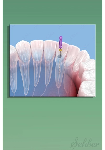 Endodontik Kök Kanal Tedavi Sürecinin 3d Tıbbi İllüstrasyonu Yatay Kanvas Tablo Tekli 3746 Çok Renkli