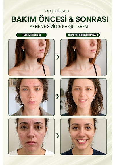 Organicsun Çay Ağacı Ve Propolisli Akne Ve Sivilce Karşıtı Cilt Bakım Kremi Siyah Nokta Ve Leke Görünümü Bakımı 50 Ml