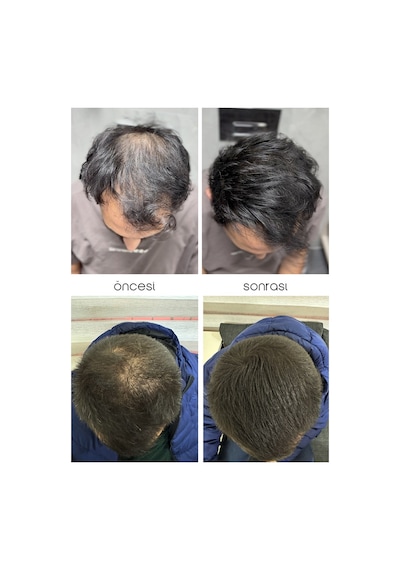 Seyrek Saç Kapatıcı Kalıcı Losyon - Saç Kapatıcı Dolgunlaştırıcı Sıvı Krem Anında Hacimli Doğal Görünüm 50ml X 2 Adet