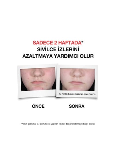 Neutrogena Sivilce Karşıtı Plus Temizleme Jeli 200 ML
