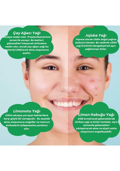 Sera Natura Acne Care Akne Karşıtı Cilt Bakım Yağı 20 ML