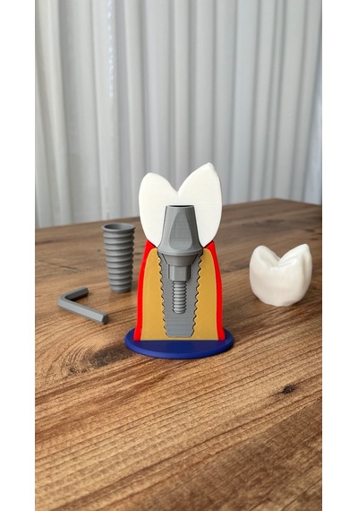 İmplant Modeli Diş Hekimliği Eğitici Model 13 CM