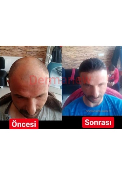 Saç Büyüme Serumu, Hair, 50 Ml, 10'lü Set - Hair
