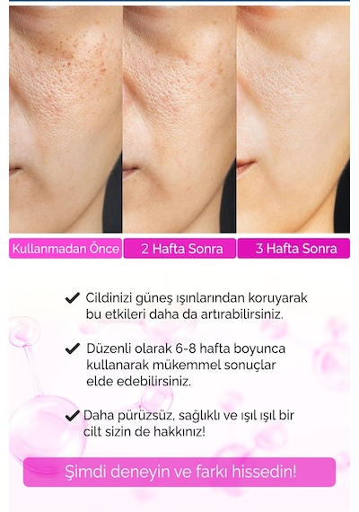 Devida Sivilce Karşıtı Siyah Nokta Akne Temizleyici Serum Elixir Series A260