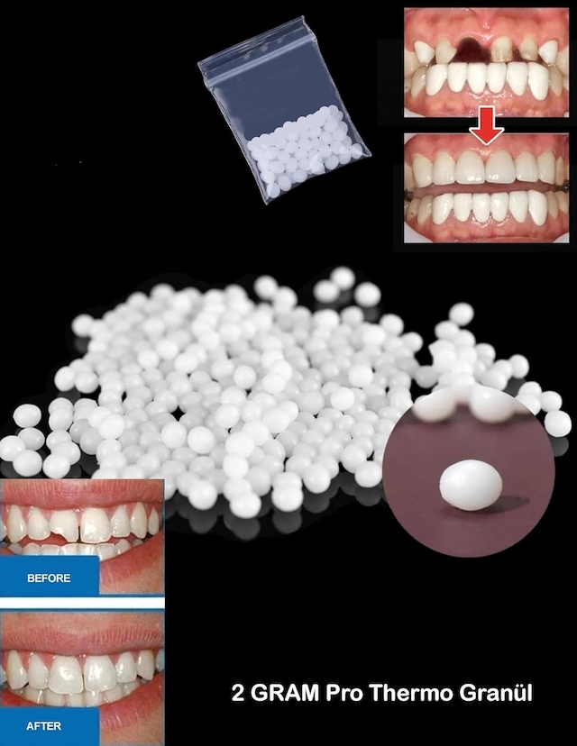 Thermo Granül 2 Gram Protez Geçici Diş Yapımı, Eksik Diş Giderme, Kırık Diş Onarımı Ve Diş Dolgusu Granülle